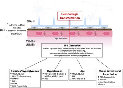 Hemorrhagic Transformation in Ischemic Stroke and the Role of Inflammation